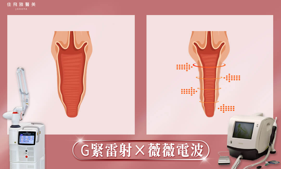 五合一生物束帶私密處緊縮術-雷射治療方式 | 佳飛雅醫美